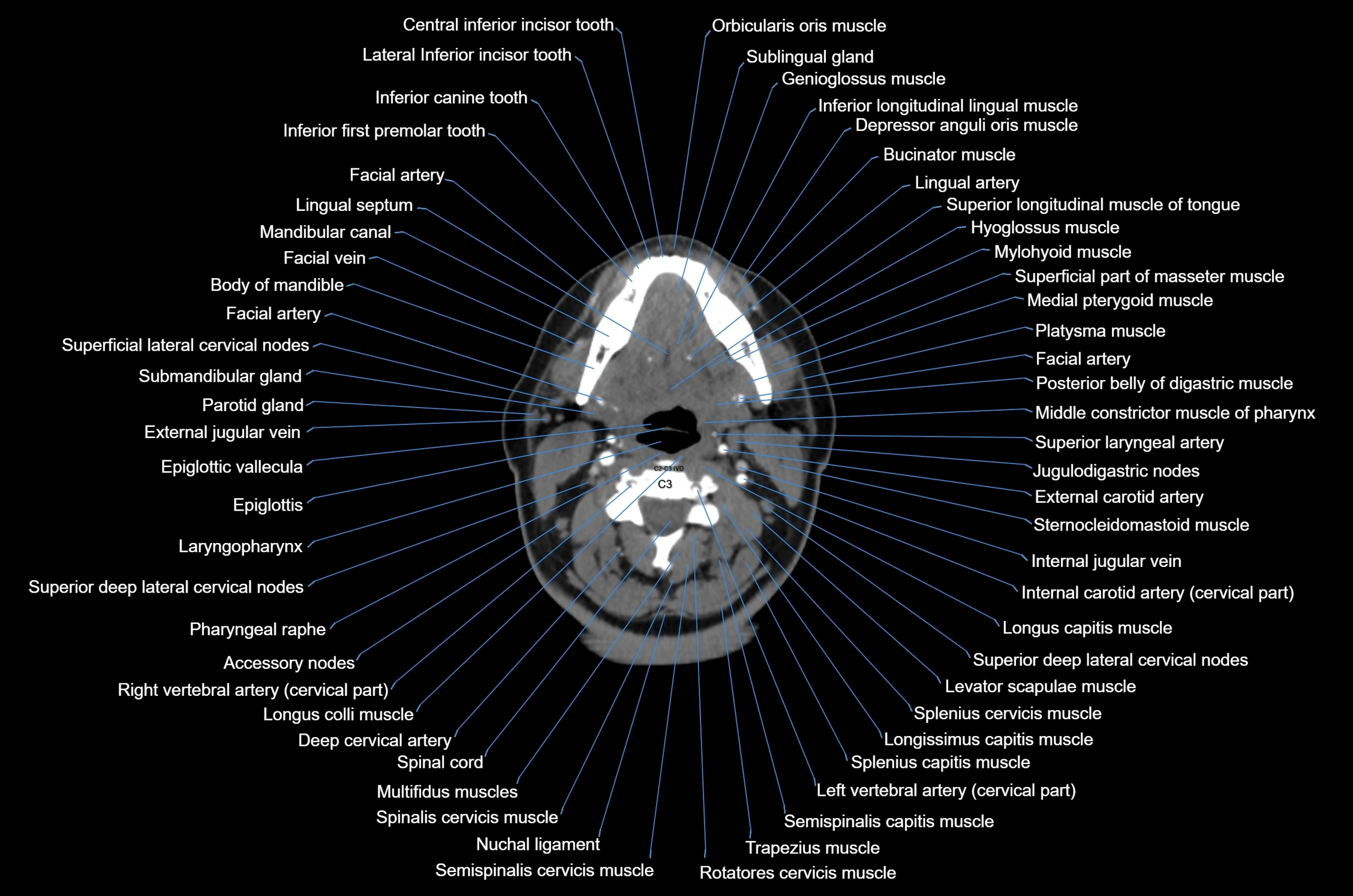 CT Neck axial cross sectional anatomy radiology image-img-00001-00033.webp